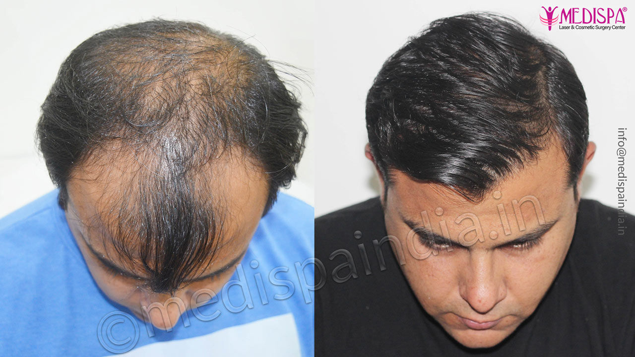 hair transplant cost in dubai