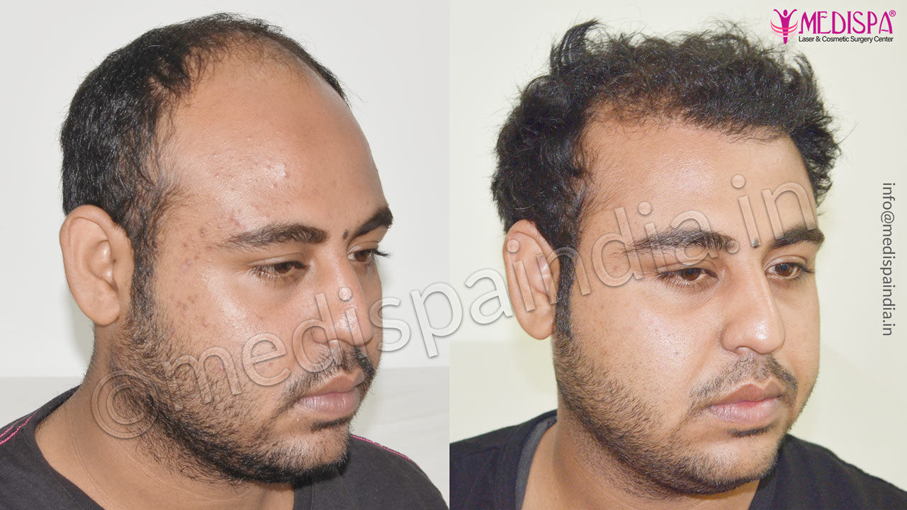 hair transplant clinics in dehradun