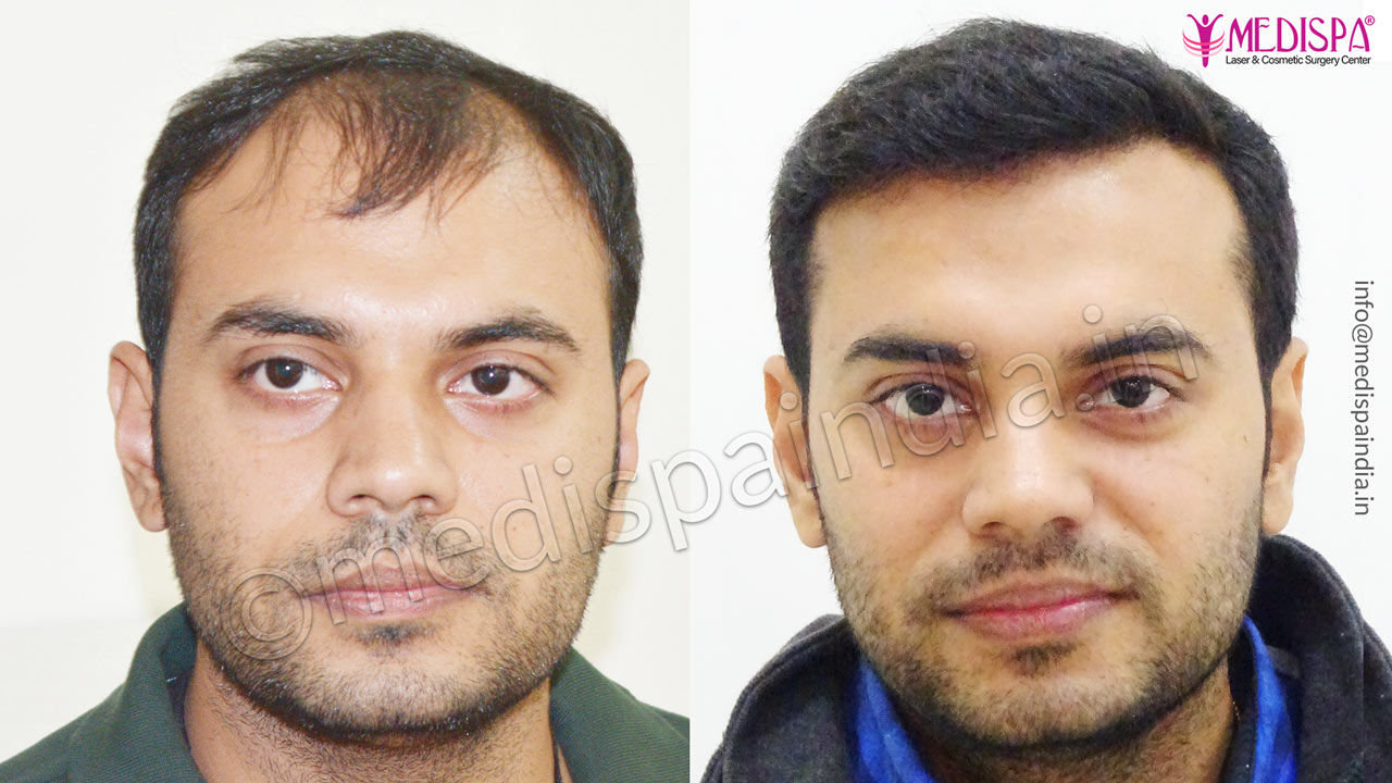 hair transplant clinics in delhi