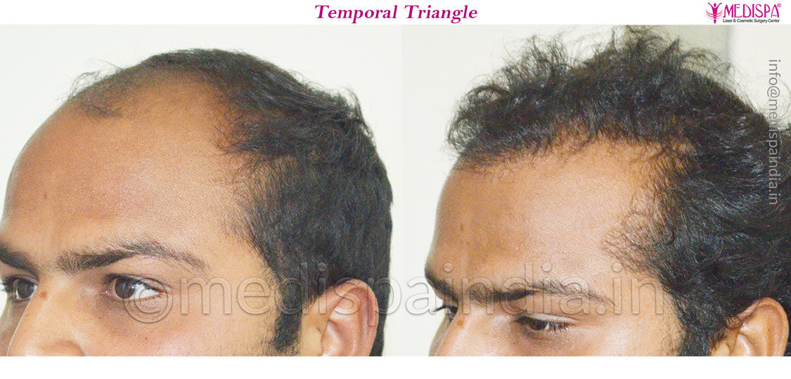 hair transplant clinics in greater kailash delhi