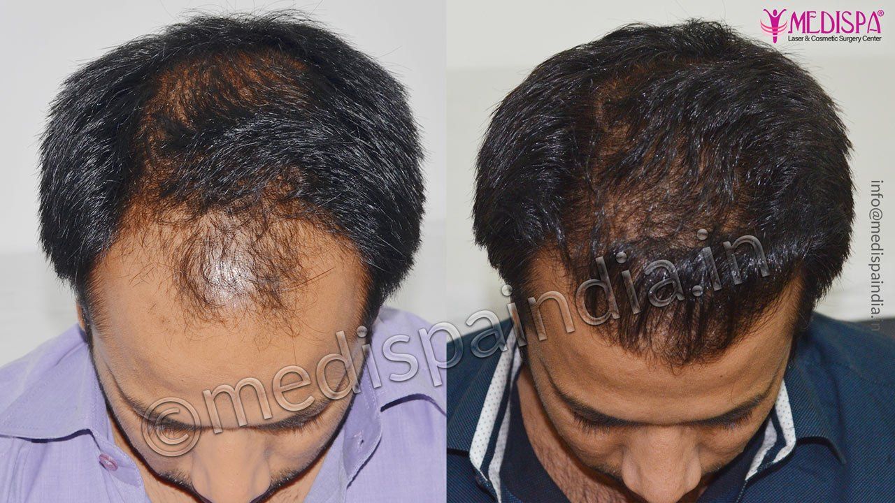 hair transplant clinics in gurugram