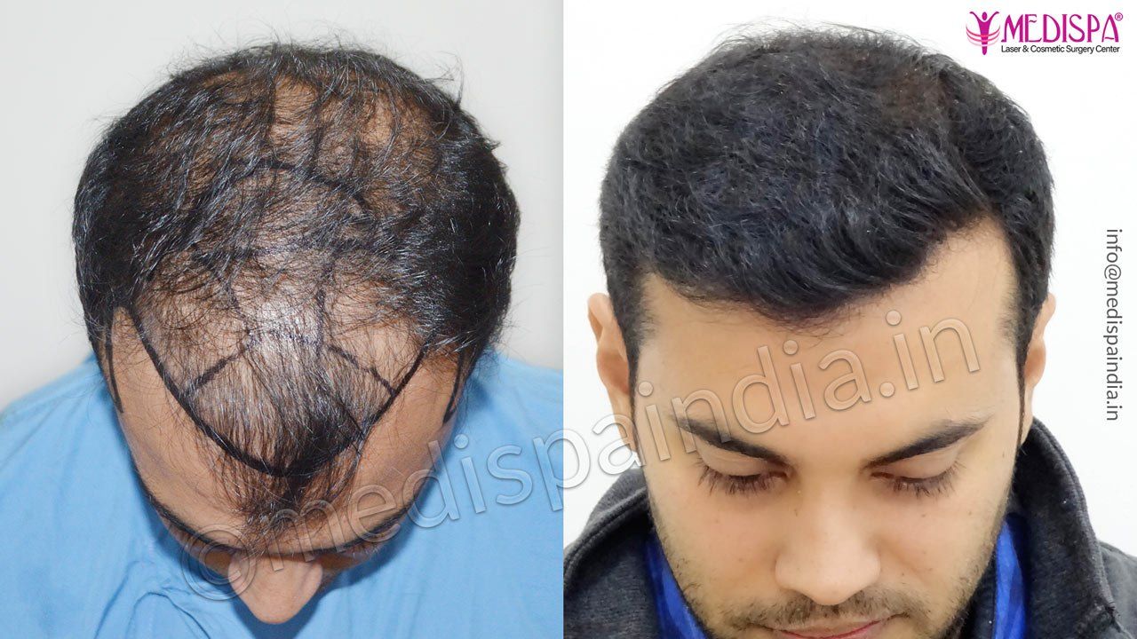 hair transplant result after 7 months