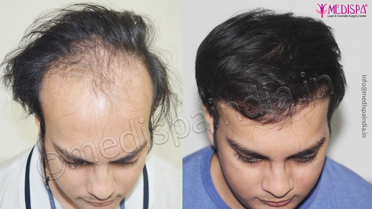 hair transplant clinics in jodhpur