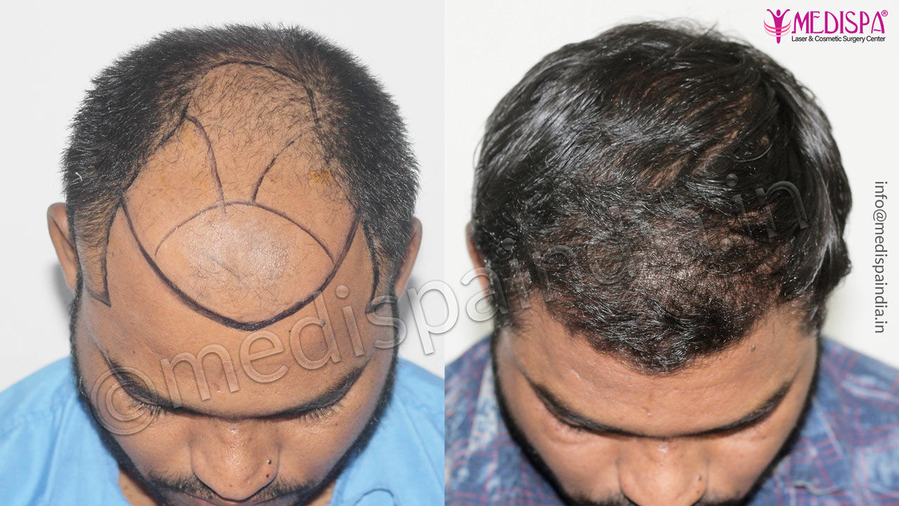 hair transplant clinics in nigeria