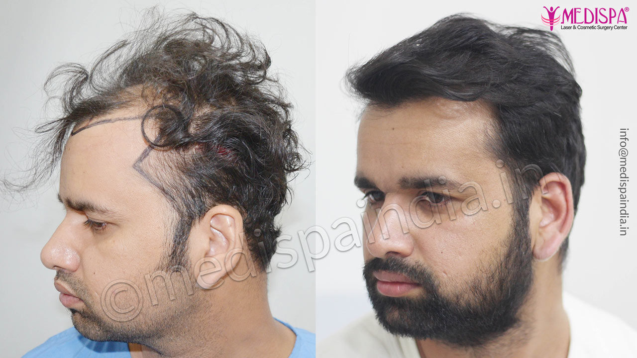 hair transplant clinics in sydney australia