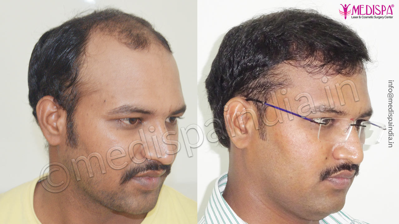 hair transplant cost bangalore