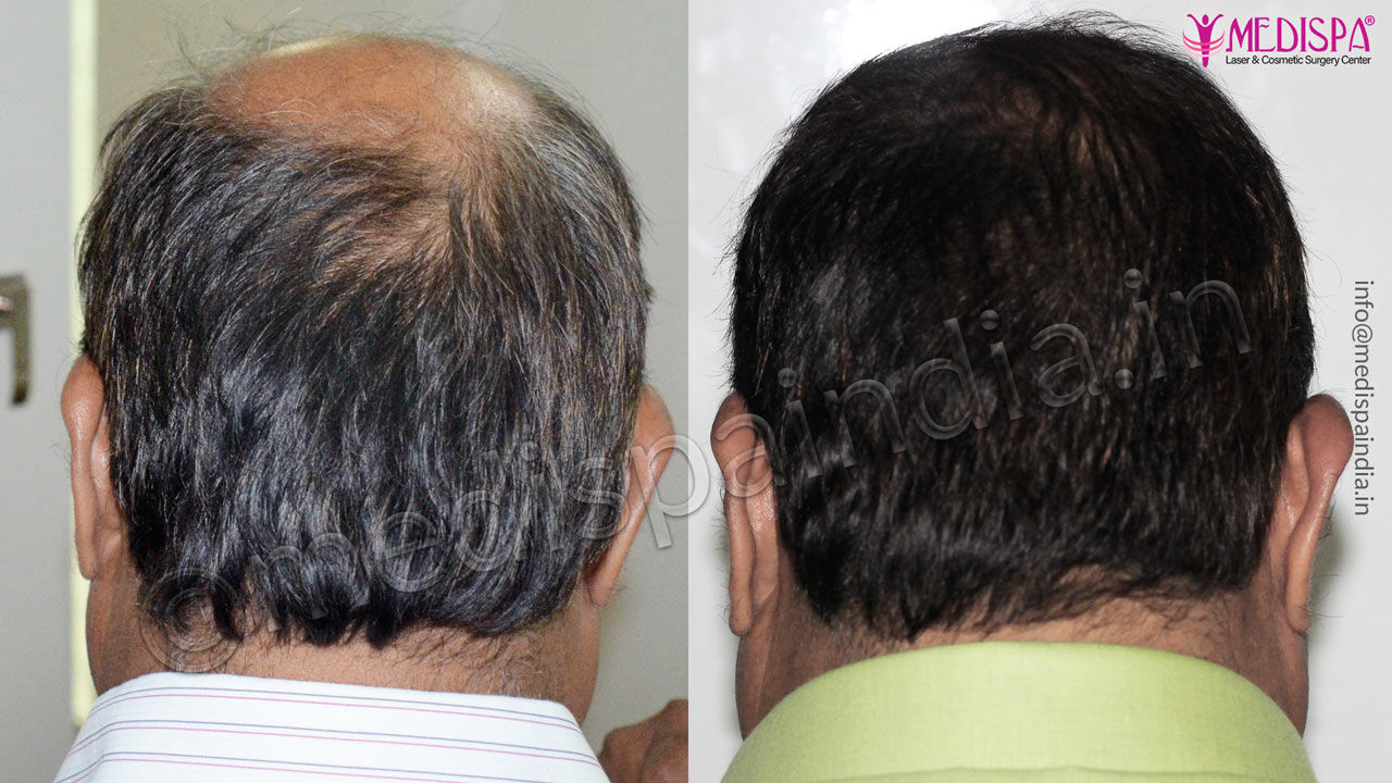 hair transplant cost dubai