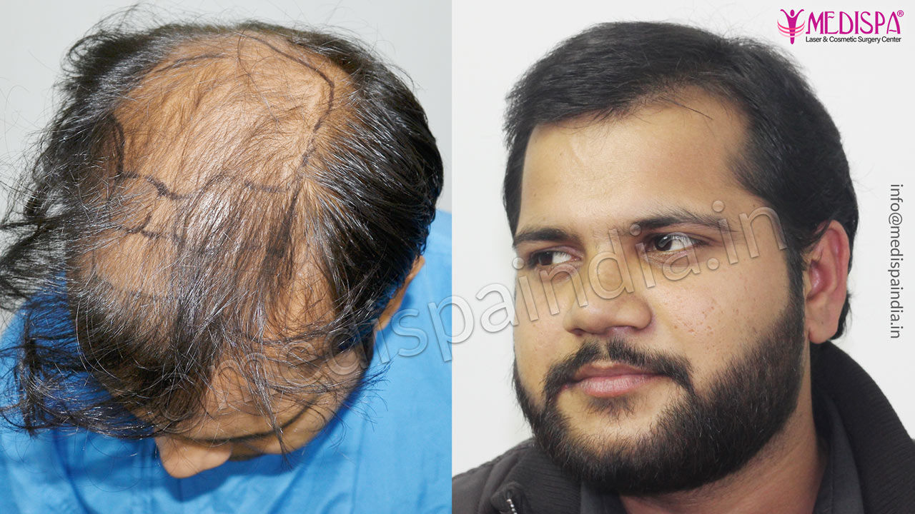 hair transplant cost Hyderabad
