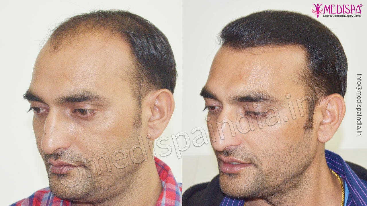 hair transplant cost in bikaner