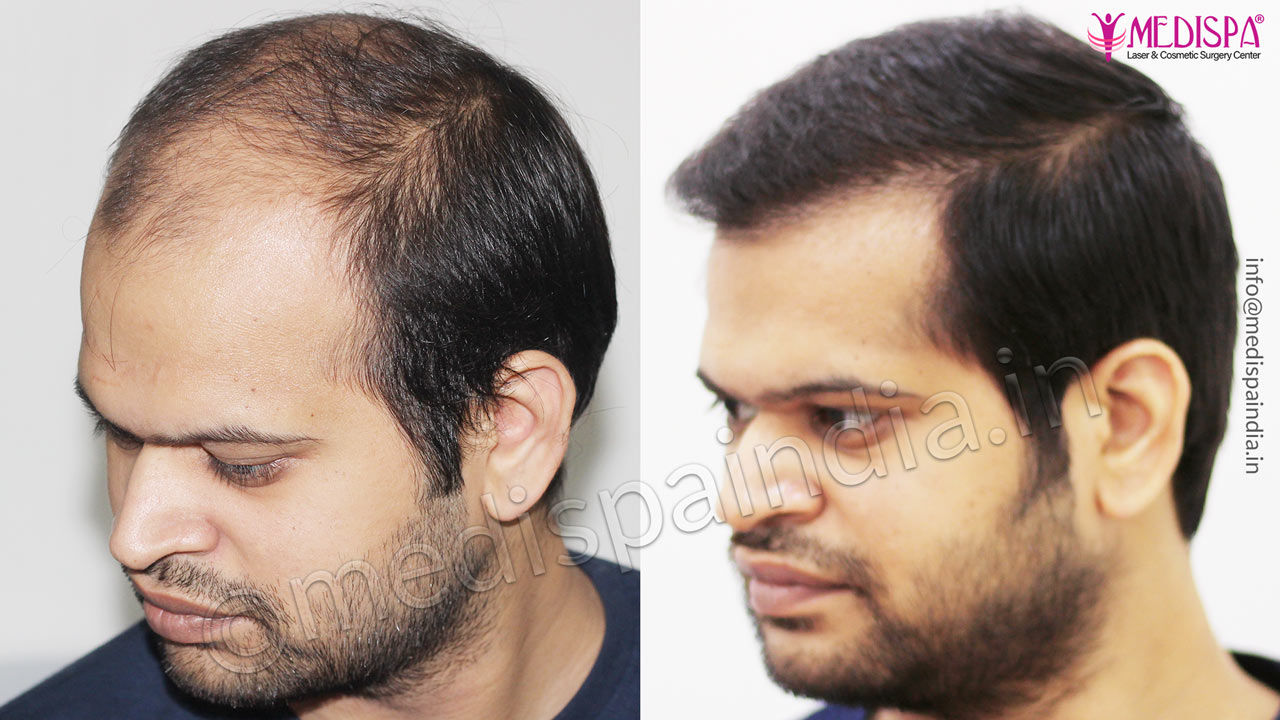 hair transplant cost in bikaner