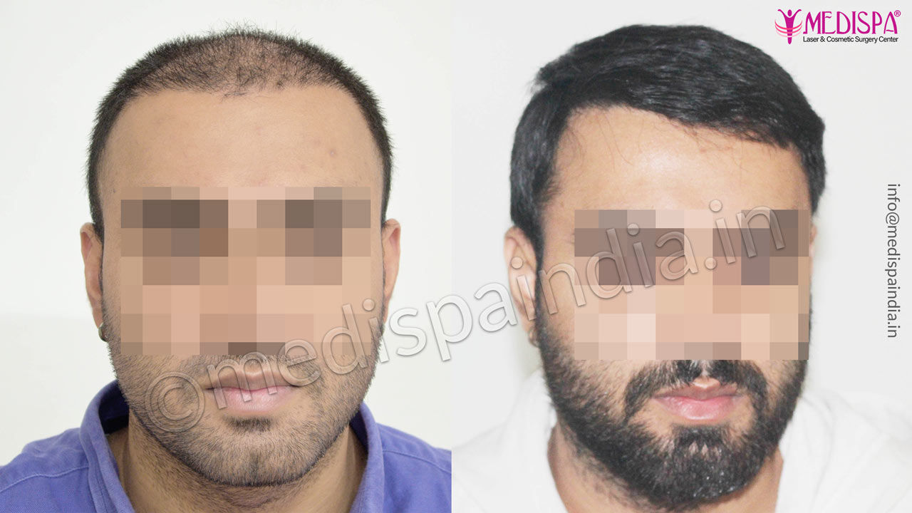 hair transplant cost in canada