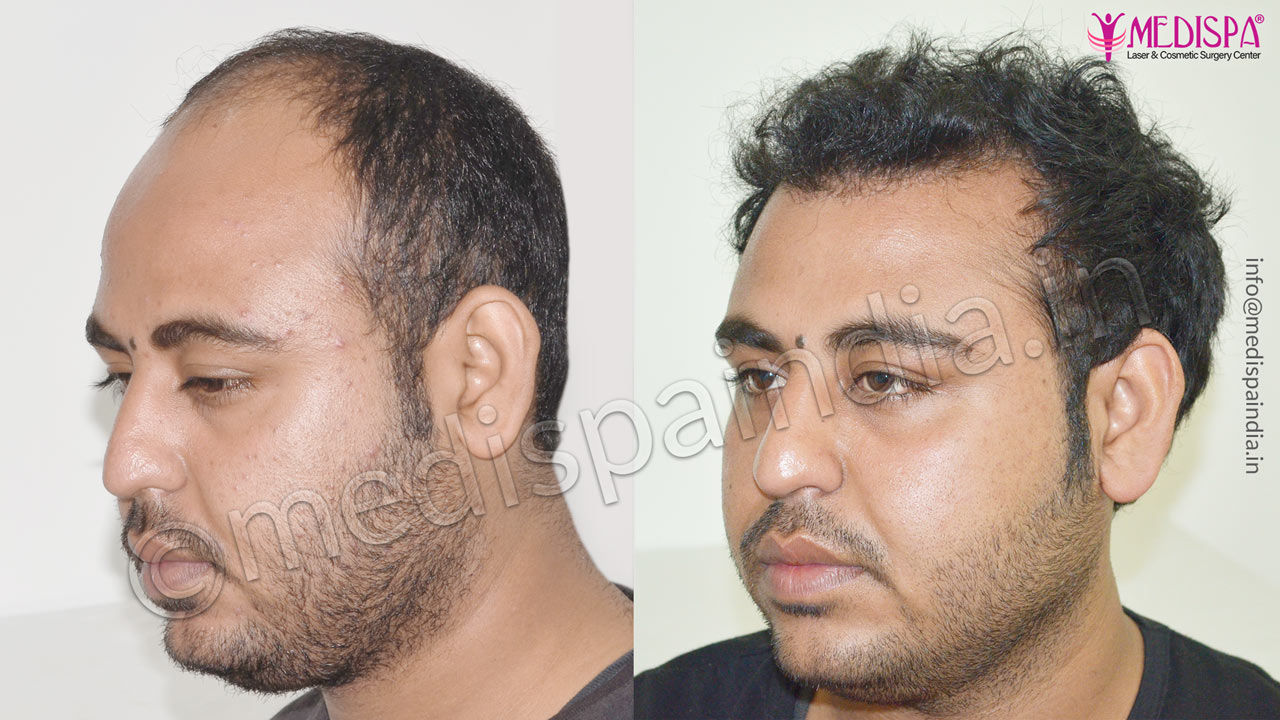 hair transplant cost in dehradun