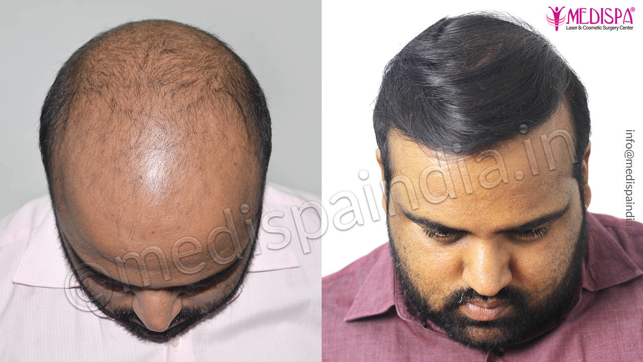 hair transplant result after 7 months