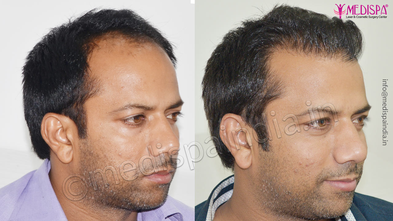 hair transplant cost in gurugram