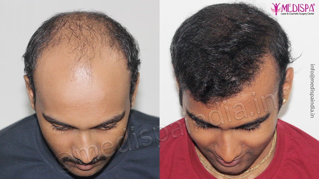 hair transplant cost in jaipur