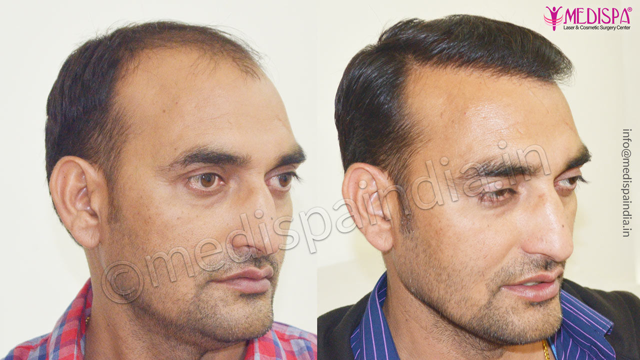 hair transplant cost in jodhpur