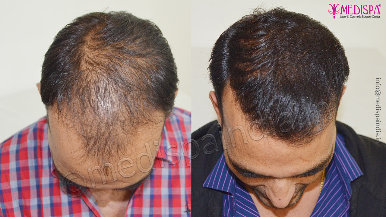 hair transplant cost in dubai