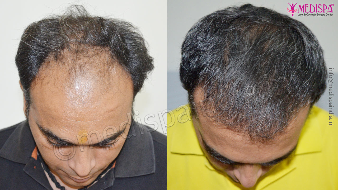 Hair Transplant Results – Shri Hari Skin Care
