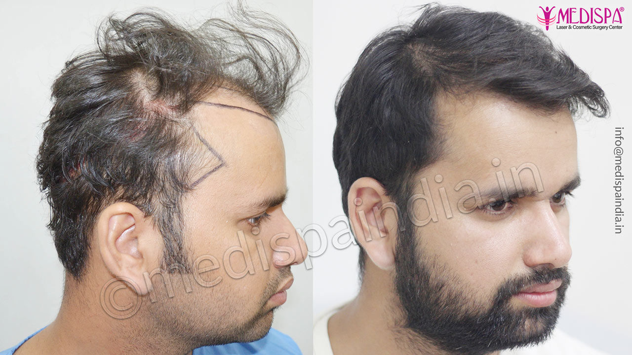 hair transplant cost in sydney