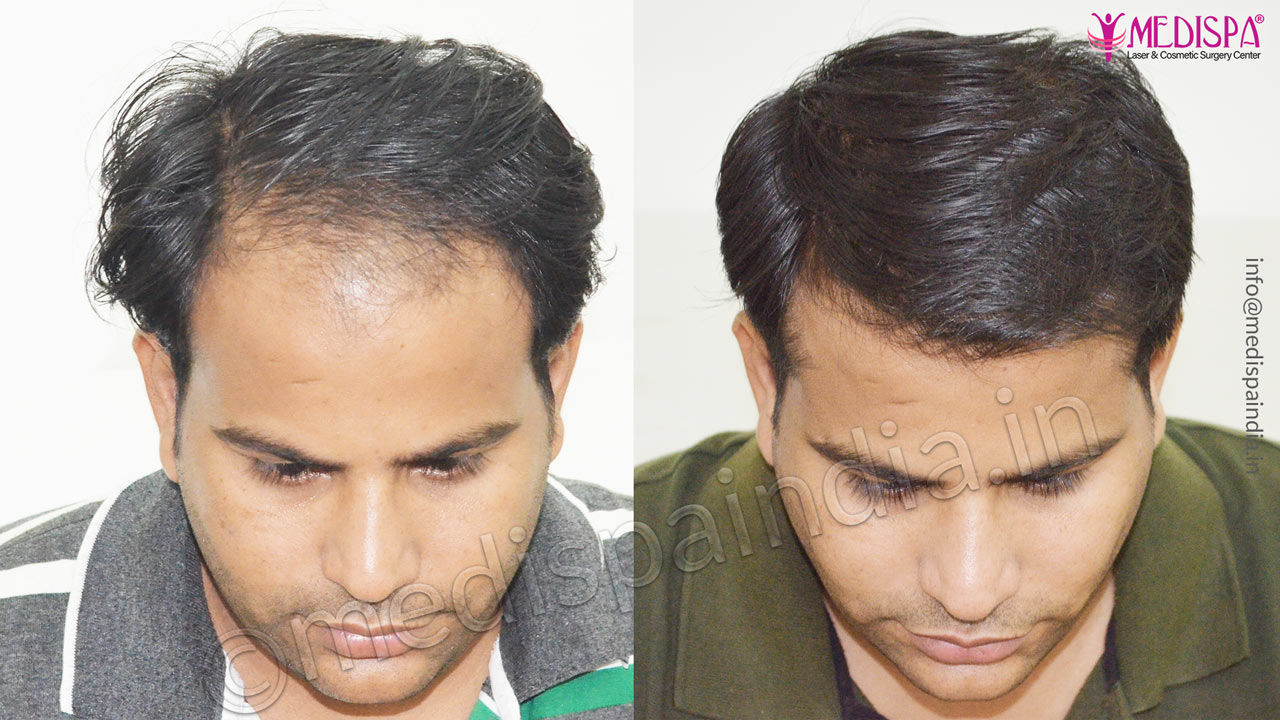 hair transplant cost in toronto