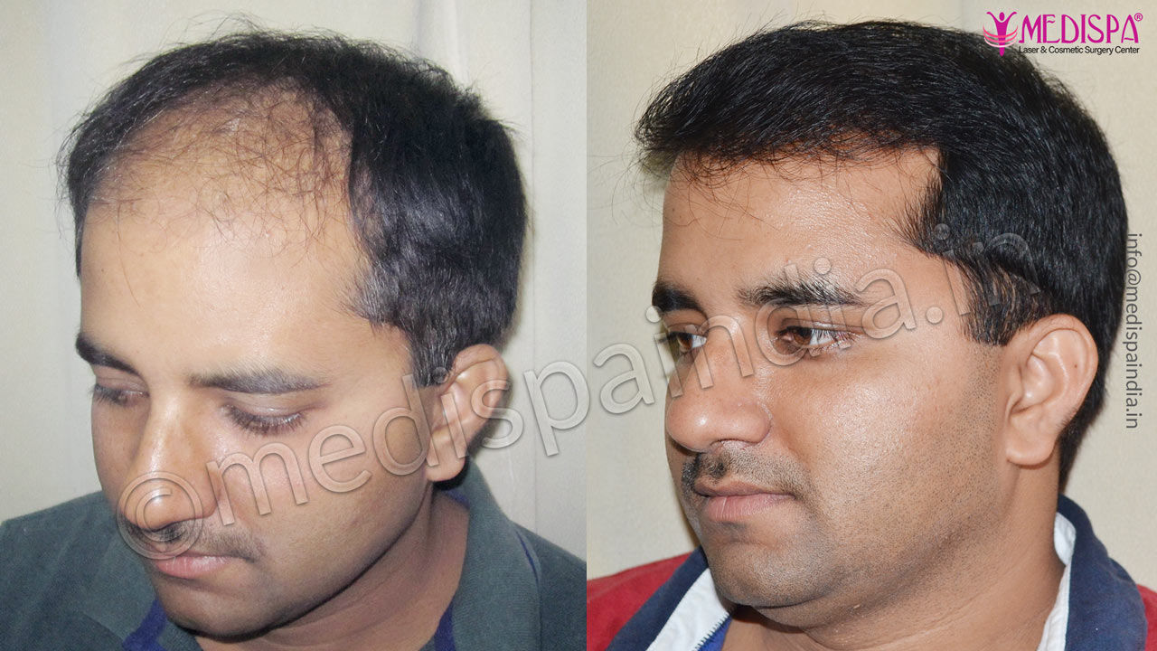 hair transplant cost in turkey