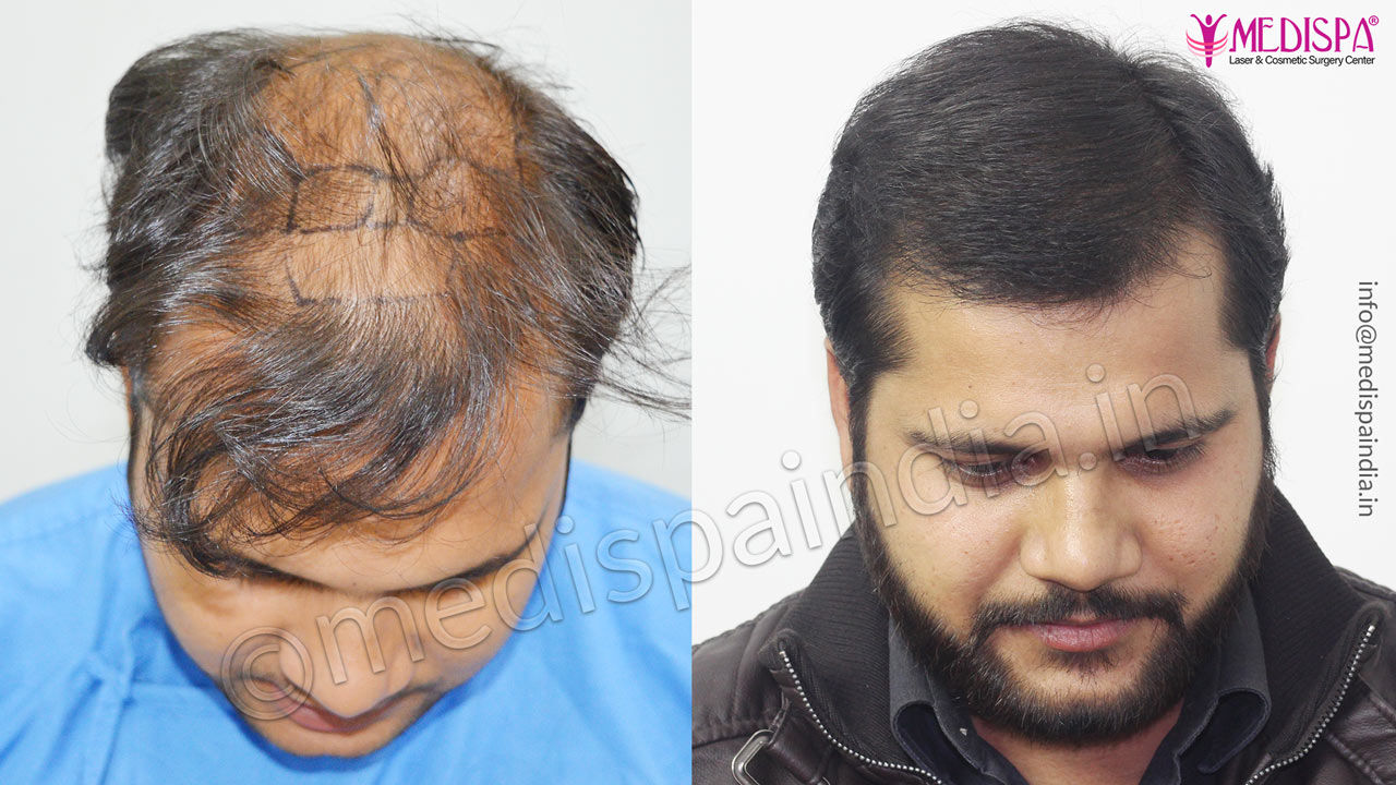 hair transplant cost in india