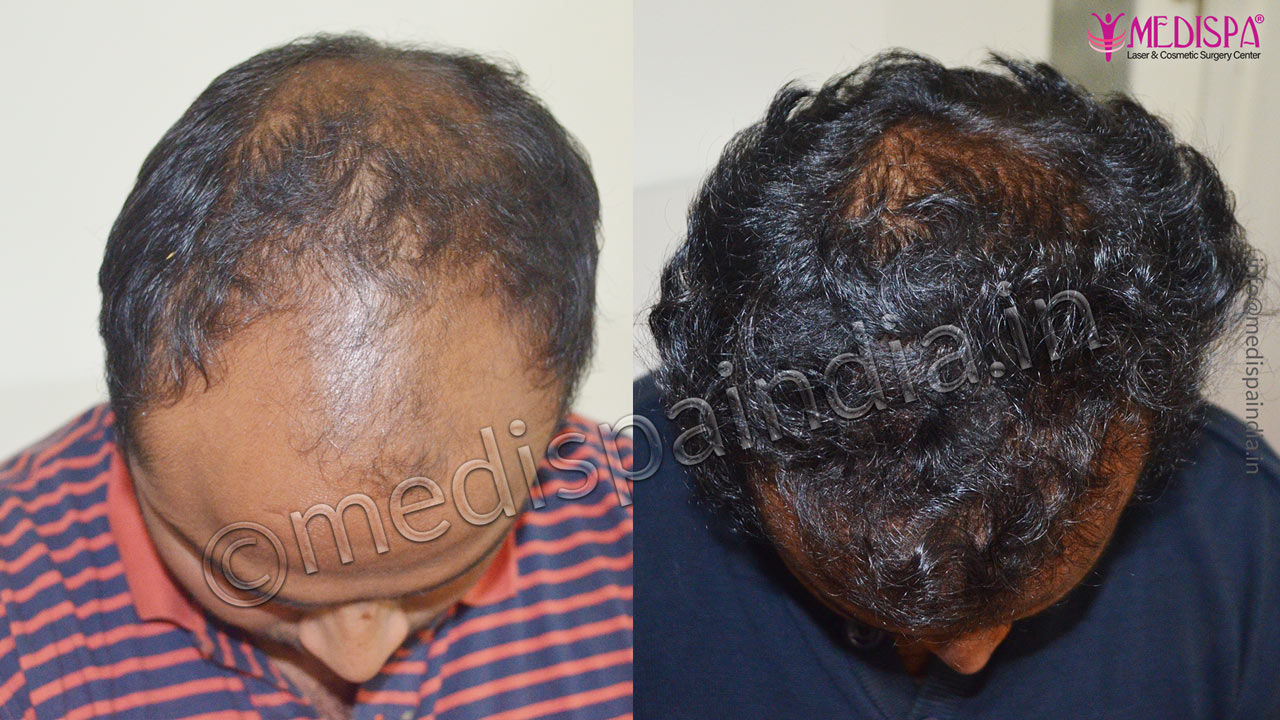 hair transplant doctors in south delhi