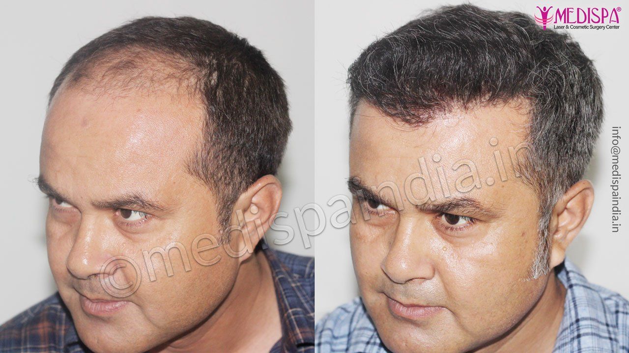 hair transplant dubai after before