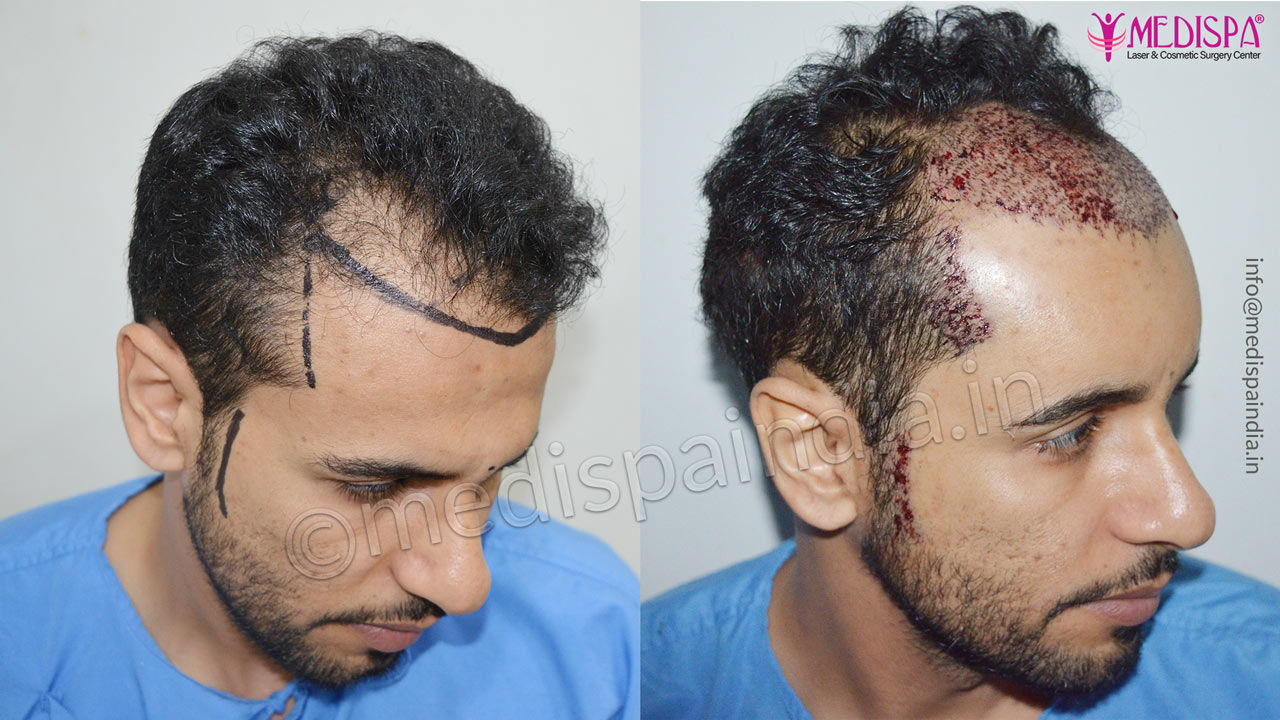 hair transplant dubai result