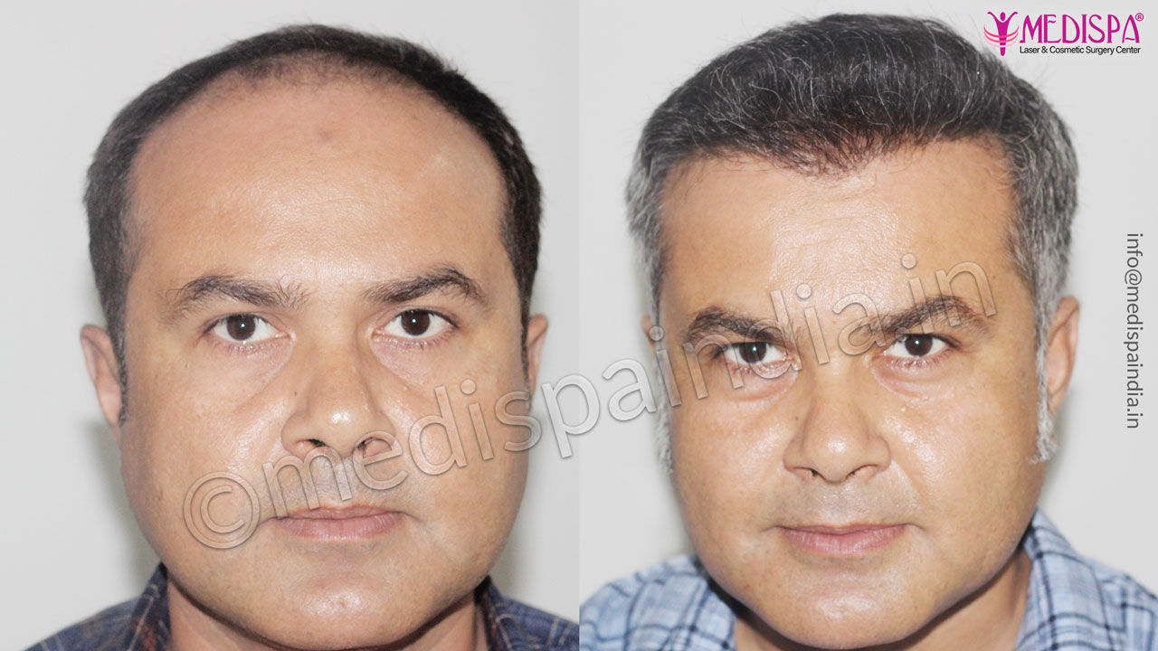 celebrity hair transplant result 