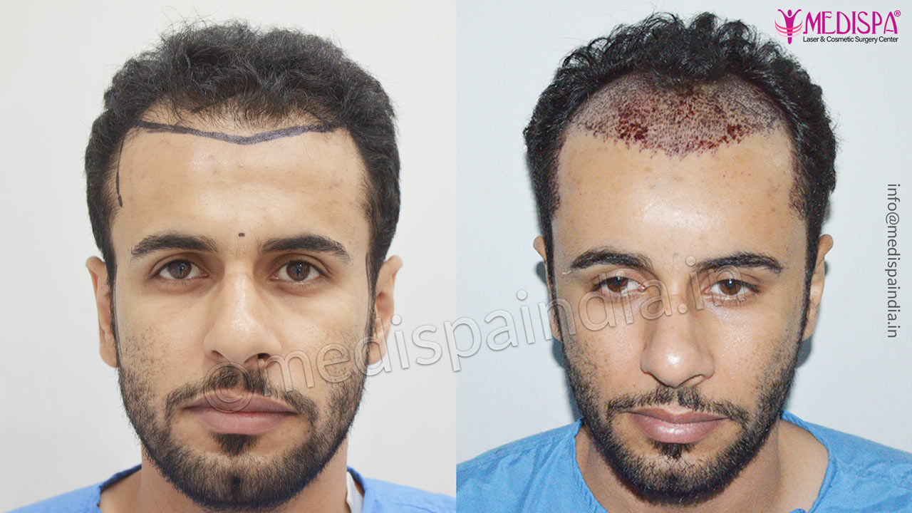 hair transplant dubai