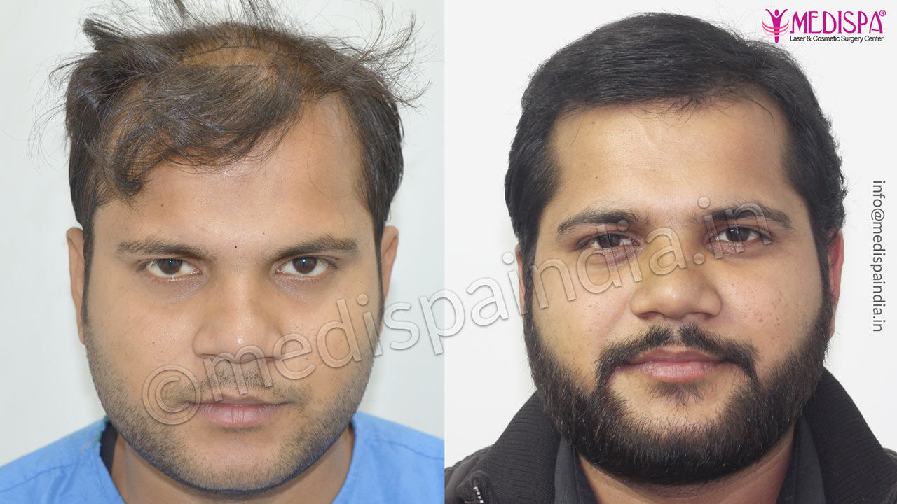 hair transplant gurugram cost