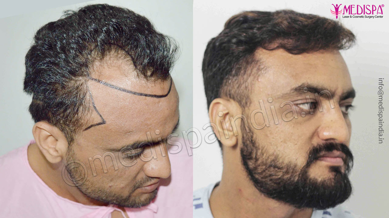 hair transplant in australia