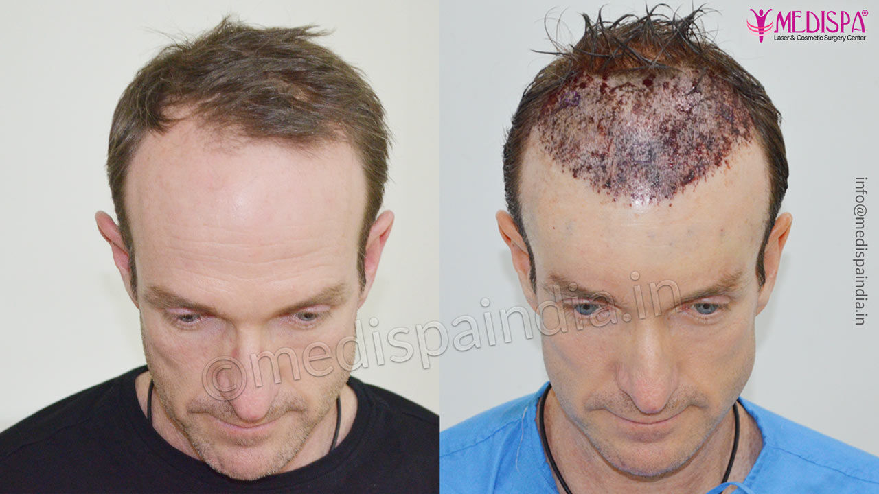 hair transplant in australia