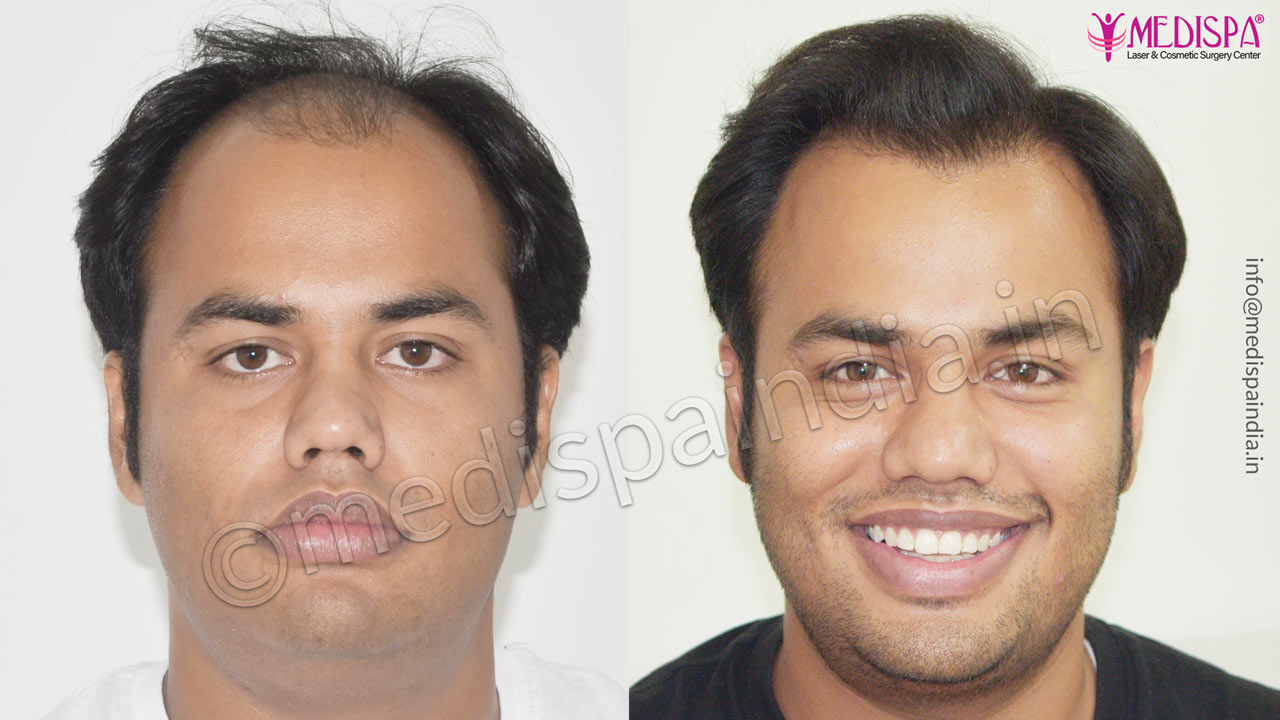 hair transplant in bikaner