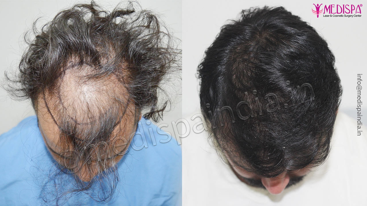 hair transplant in canberra australia