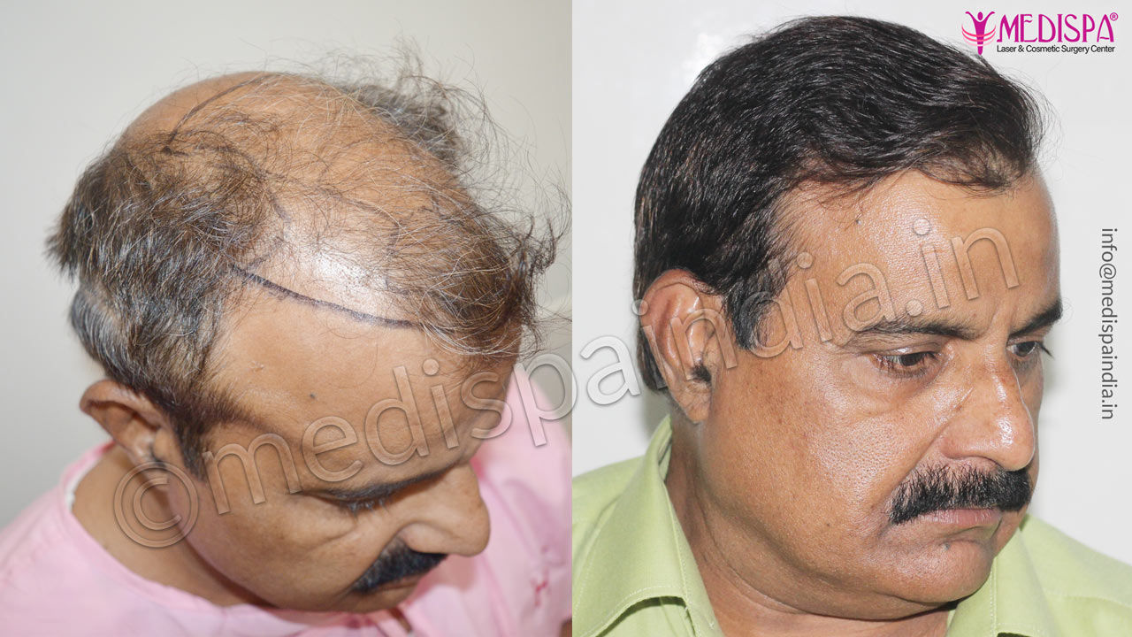 hair transplant in dubai