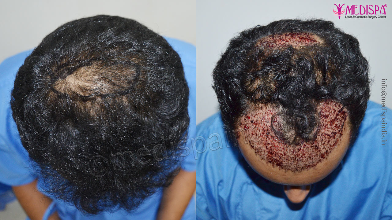 hair transplant in dubai