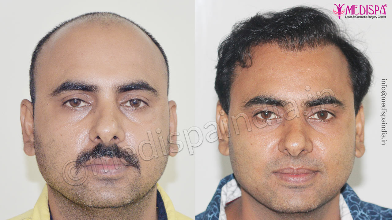 hair transplant in faridabad