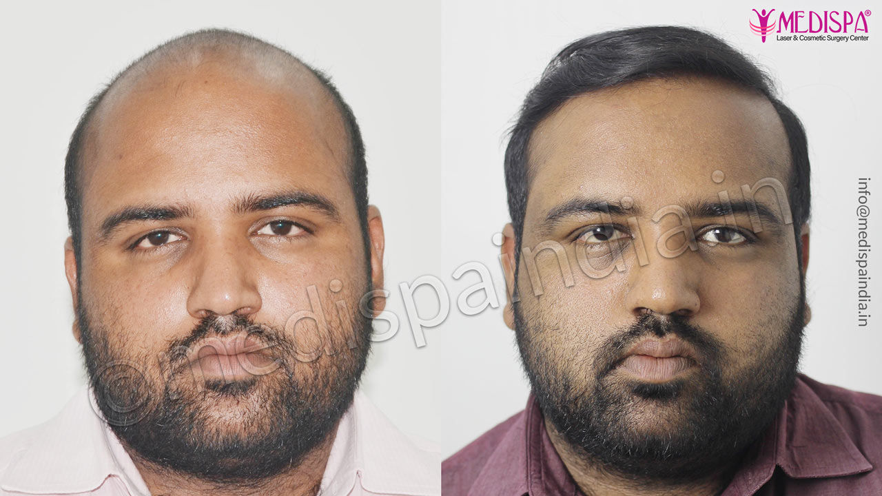 hair transplant in gurgaon