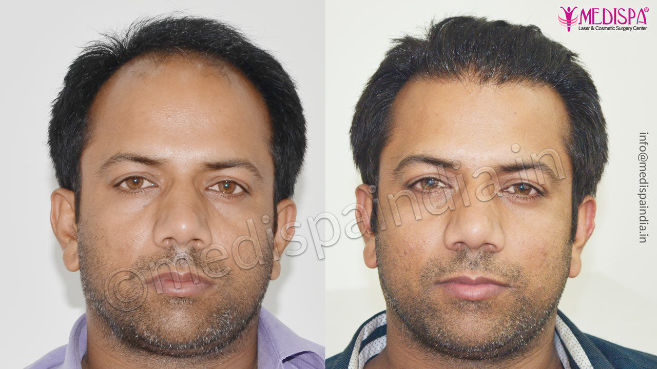 hair transplant cost in dubai