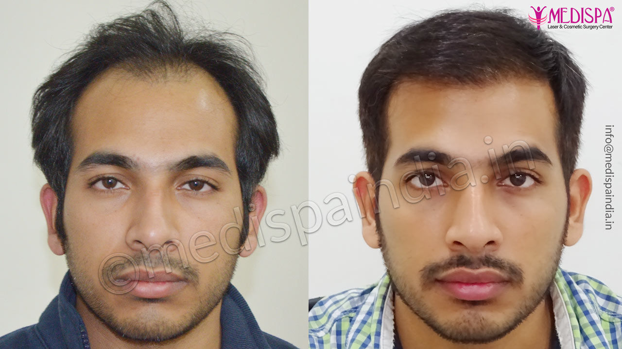 celebrity hair transplant result 