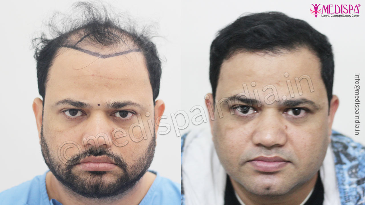 celebrity hair transplant result 