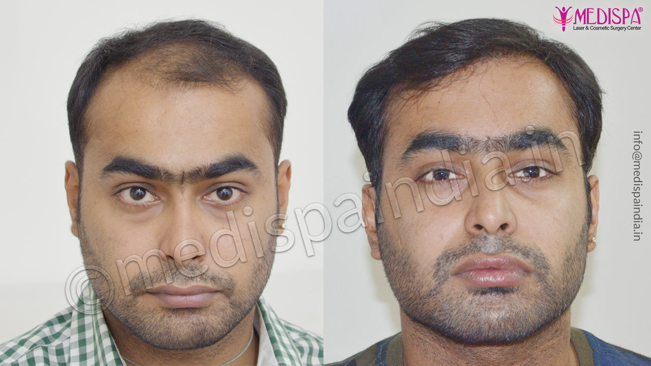 hair transplant in indore