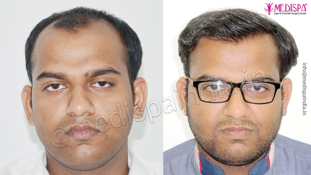 hair transplant delhi cost