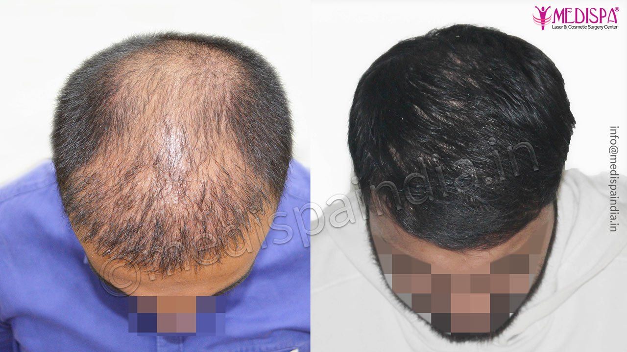 hair transplant in jammu and kashmir