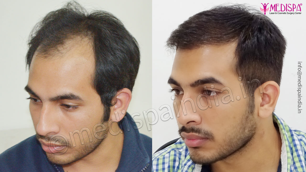 Hair Transplant Results in Haryana, Before After Photos