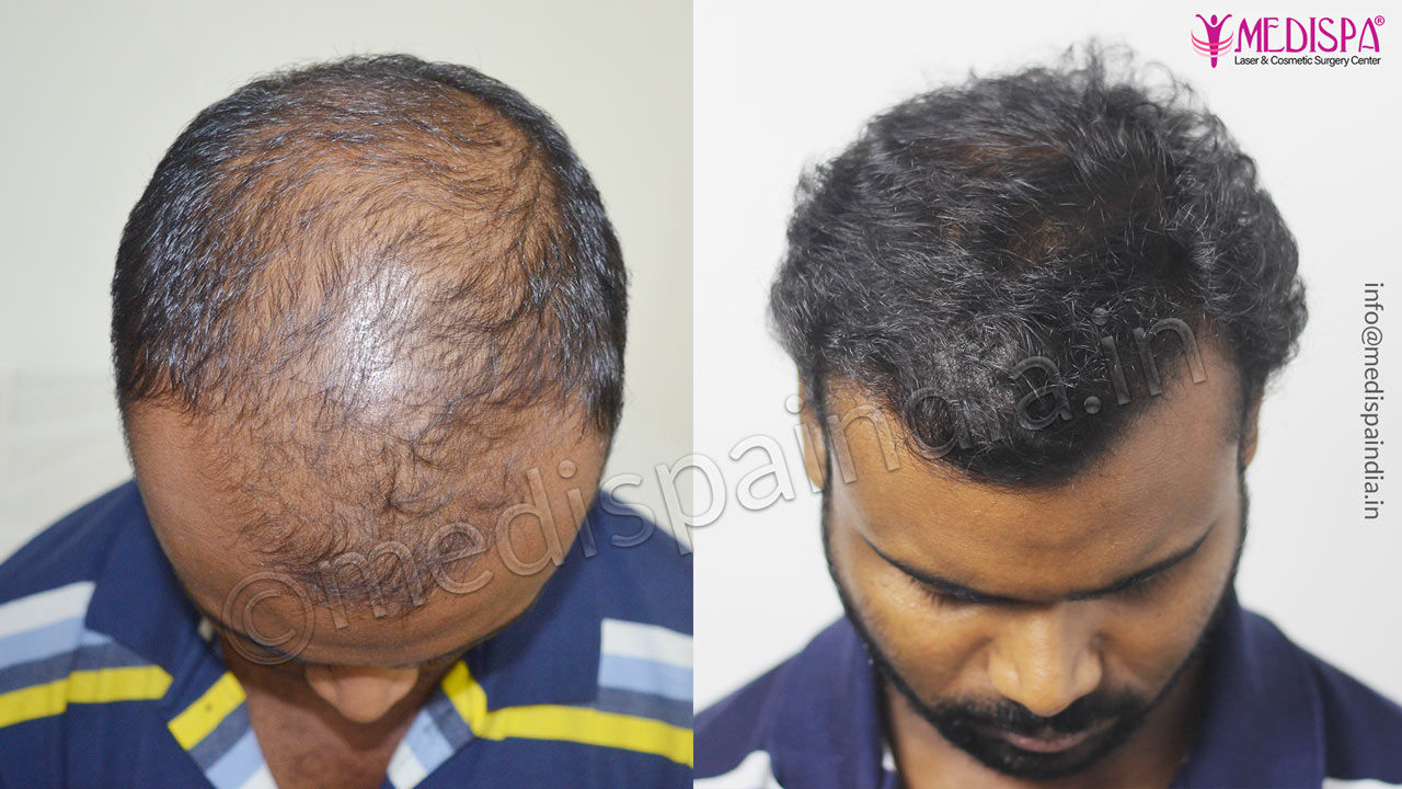 celebrity hair transplant result 