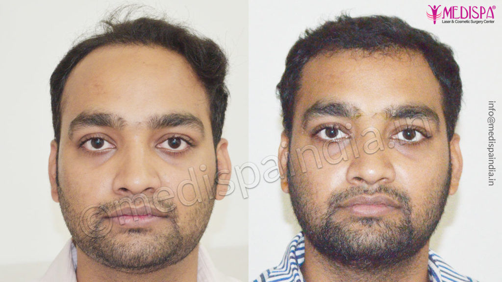 Best Hair transplant in India