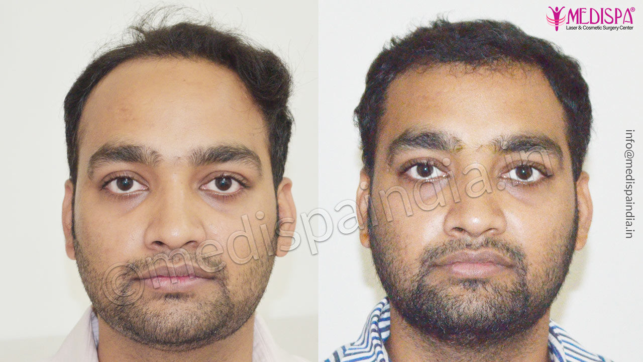 hair transplant cost in dubai